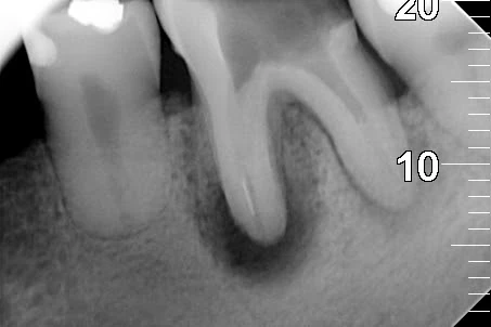 endodoncja leczenie kanalowe